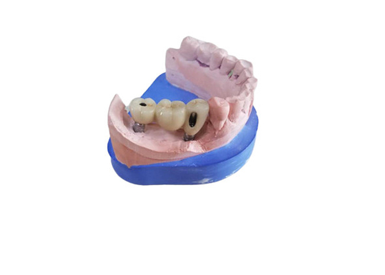 Οδοντική κορώνα CAM Zirconia CAD με τη συναρμογή Zirconia βάσεων τιτανίου
