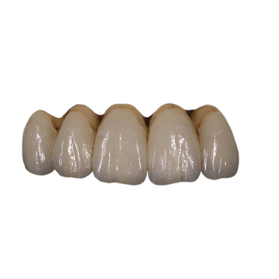 Εύκολος διατηρήστε τη Orthodontic PFM σταθερότητα χρώματος κορωνών πορσελάνης οδοντική