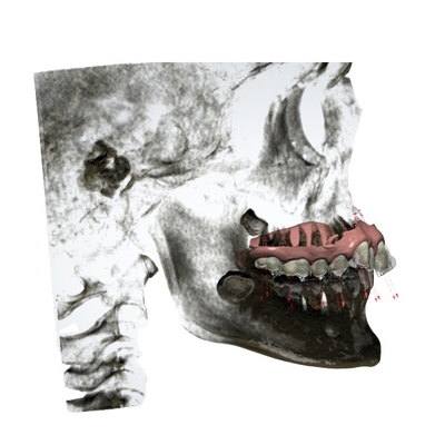 Το προσαρμοσμένο λάστιχο καθόρισε τις Orthodontic συσκευές εύκολες διατηρεί
