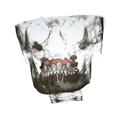 Ακριβής μετακινούμενος Orthodontic γρήγορος υπερώιος αποσυμπιεστής cOem συσκευών