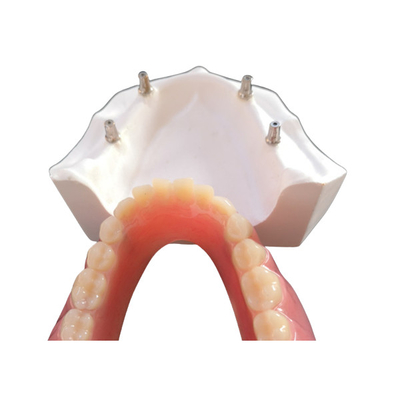 Το άνετο οδοντικό μόσχευμα Overdenture CAM CAD εύκολο διατηρεί