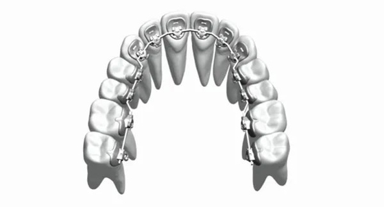 Η συνήθεια καθόρισε τα Orthodontic στηρίγματα συσκευών ισιώνει το ανοξείδωτο Bioceramic δοντιών