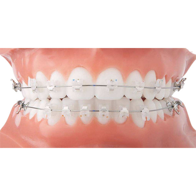 Εύκολες καθαρές Orthodontic κεραμικές όμορφες σταθερές Orthodontic συσκευές υποστηριγμάτων