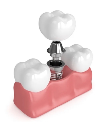 Εμφυτεύματα True Dentures Μονά Όλες οι κεραμικές οδοντοστοιχίες Λείπουν σφραγίσματα δοντιών
