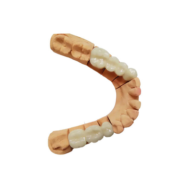 Υψηλής ποιότητας PFM Dental Crown Ρεαλιστική εμφάνιση Χρώμα σταθερό Δεν είναι εύκολο να φορεθεί