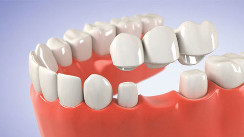 Σταθερό χρώμα χρώματος CrownRealistic Porcelai μη εύκολο να σπάσει την πορσελάνη