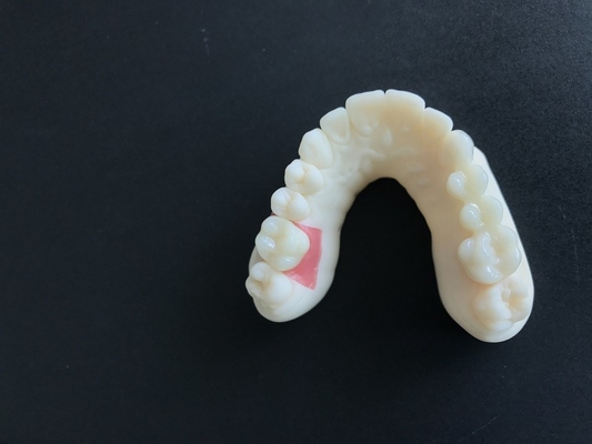 Ψηφιακή στοματική σάρωση PFM Dental Crowns Bridge Εμφυτευματολογία Απαιτήσεις