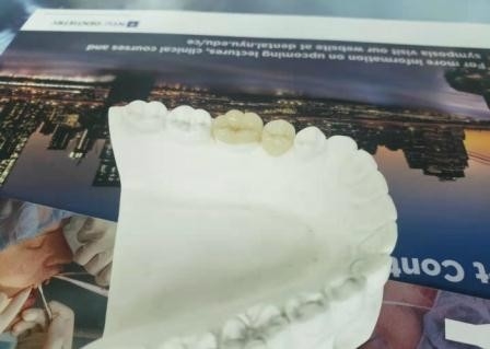 Ανθεκτικό εύκαμπτο PFM γεφυρών κορωνών οδοντικό Inlay Onlay Τύπου ΔΙΕΘΝΏΝ ΕΙΔΗΣΕΟΓΡΑΦΙΚΏΝ ΠΡΑΚΤΟΡΕΊΩΝ Ε ανώτατο