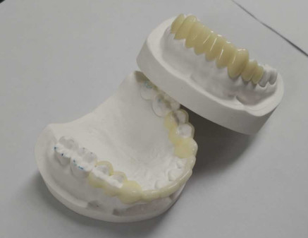 Υψηλής αντοχής CAD CAM 3D Printing Temporary Crowns Durable Resin