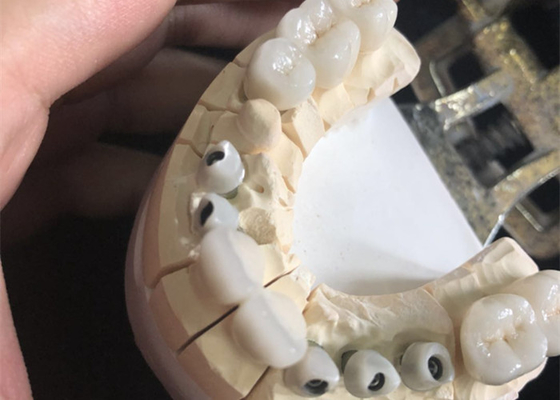 Οδοντικές κορώνες άριστο Biocompatibility Zirconia μετάλλων ελεύθερες άσπρες