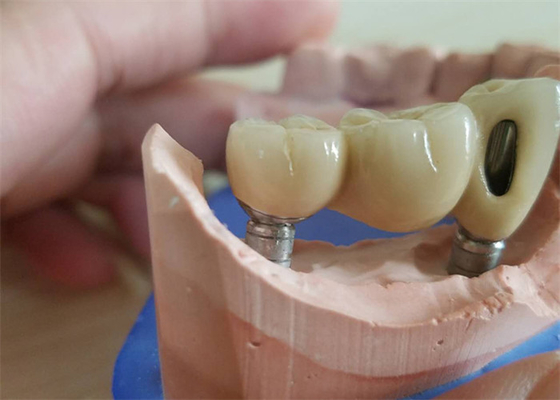 Οδοντική κορώνα CAM Zirconia CAD με τη συναρμογή Zirconia βάσεων τιτανίου