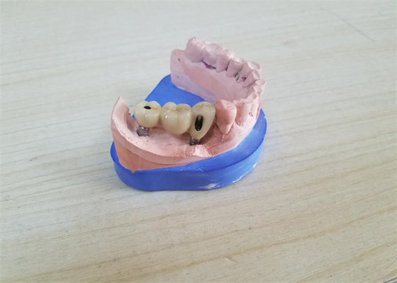 Οδοντική κορώνα CAM Zirconia CAD με τη συναρμογή Zirconia βάσεων τιτανίου