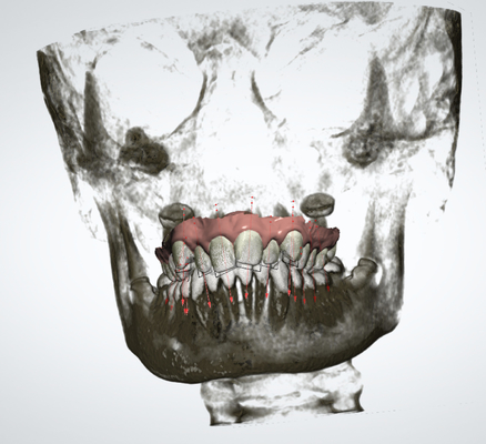 Ακριβής μετακινούμενος Orthodontic γρήγορος υπερώιος αποσυμπιεστής cOem συσκευών