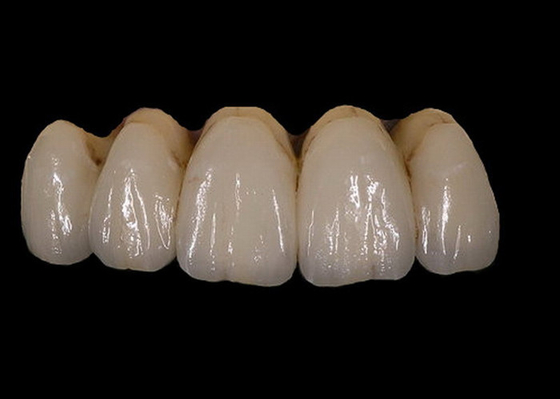 Εύκολος διατηρήστε τη Orthodontic PFM σταθερότητα χρώματος κορωνών πορσελάνης οδοντική
