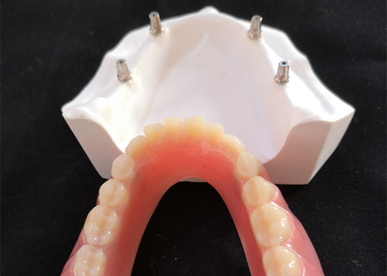 Το άνετο οδοντικό μόσχευμα Overdenture CAM CAD εύκολο διατηρεί