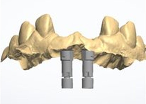 Ακριβής σχεδιασμός CAD/CAM Ζιρκόνιας οδοντικής στέμνας για τοποθέτηση