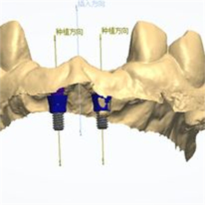 Ακριβής σχεδιασμός CAD/CAM Ζιρκόνιας οδοντικής στέμνας για τοποθέτηση