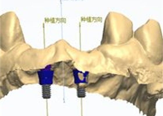 Ακριβής σχεδιασμός CAD/CAM Ζιρκόνιας οδοντικής στέμνας για τοποθέτηση