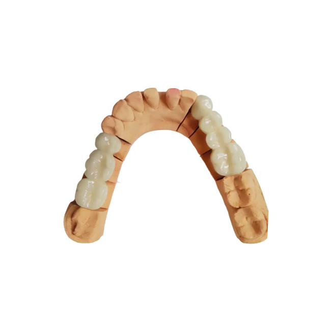 Σταθερό χρώμα PFM Dental Crown Acid and Alkali Resistance που δεν φοριέται εύκολα